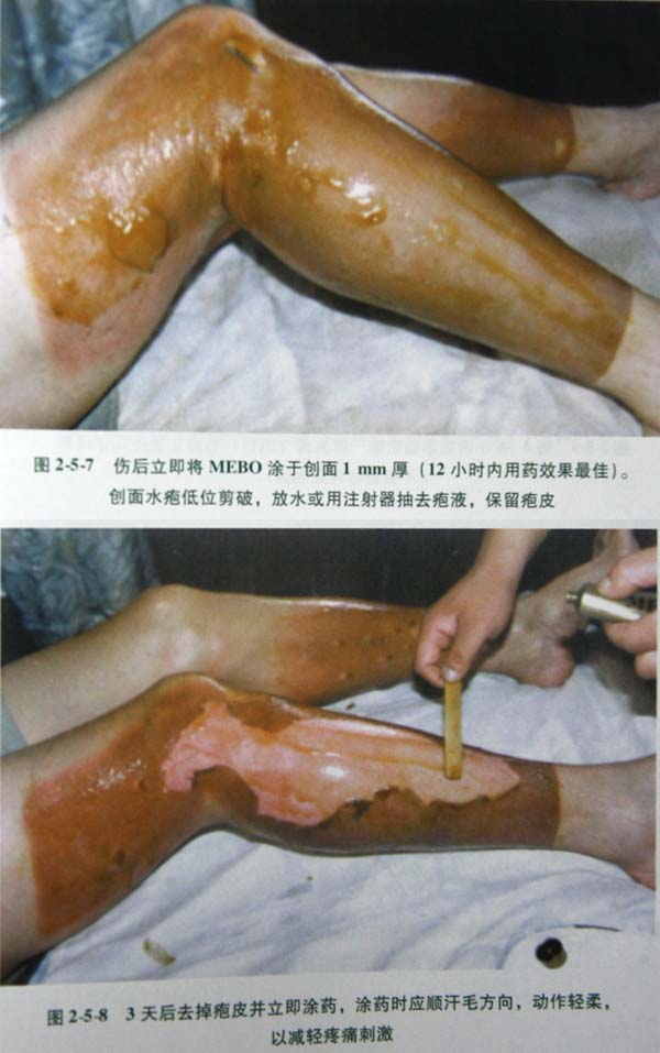 菲彩国际集团_第二节 表皮深层损伤治疗手艺