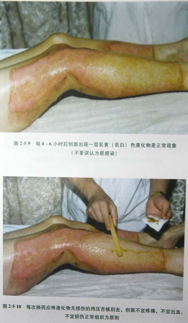 菲彩国际集团_第二节 表皮深层损伤治疗手艺