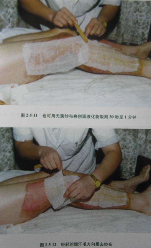 菲彩国际集团_第二节 表皮深层损伤治疗手艺