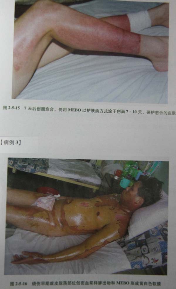 菲彩国际集团_第二节 表皮深层损伤治疗手艺