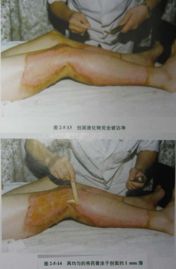 菲彩国际集团_第二节 表皮深层损伤治疗手艺
