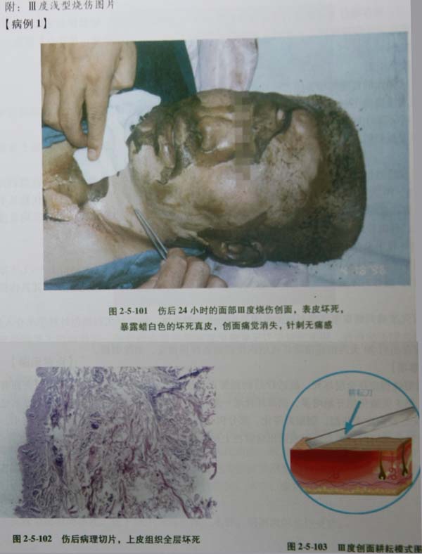 菲彩国际集团_第四节 真皮深层损伤治疗手艺
