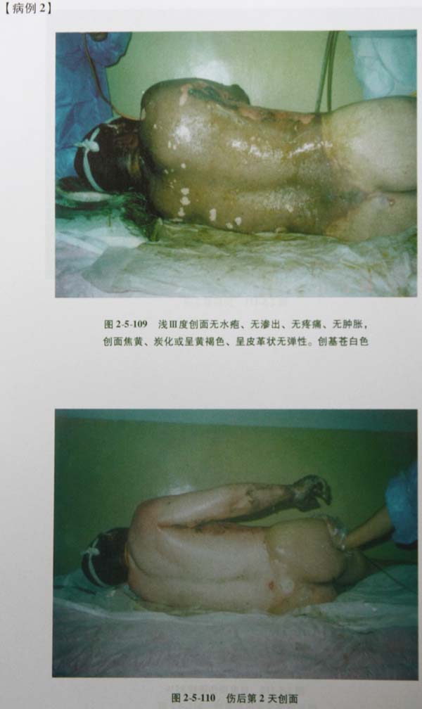 菲彩国际集团_第四节 真皮深层损伤治疗手艺