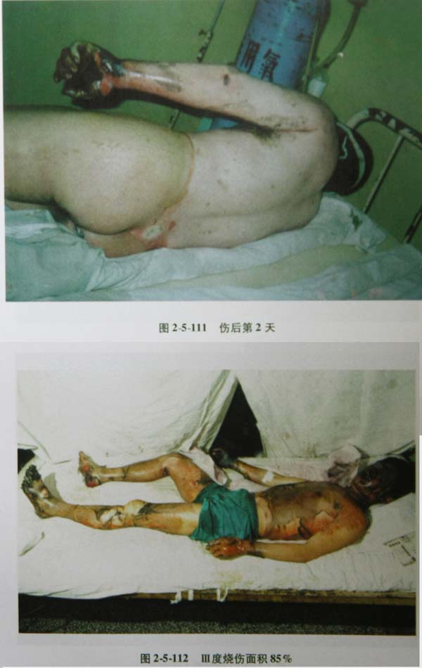 菲彩国际集团_第四节 真皮深层损伤治疗手艺