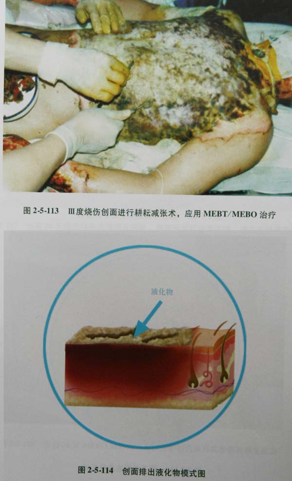 菲彩国际集团_第四节 真皮深层损伤治疗手艺