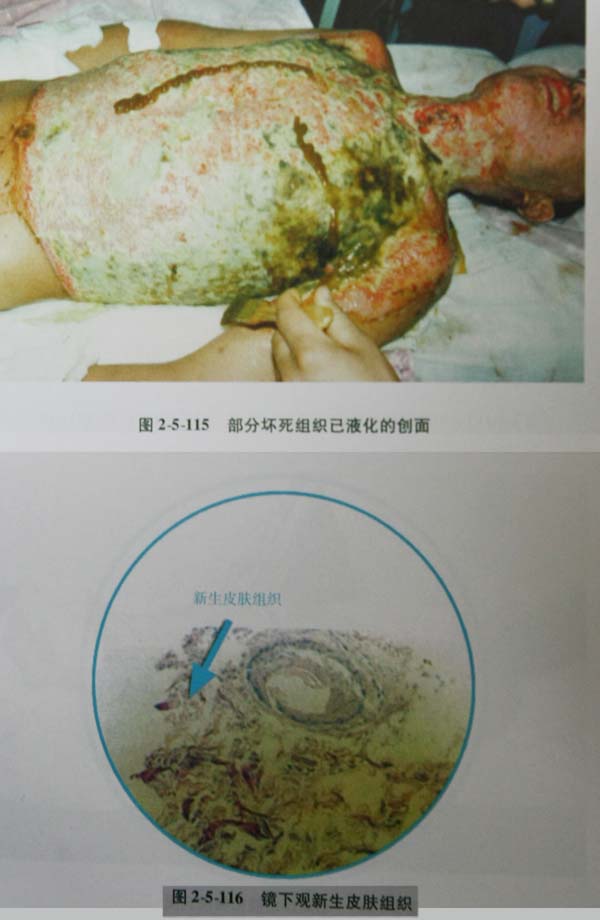 菲彩国际集团_第四节 真皮深层损伤治疗手艺