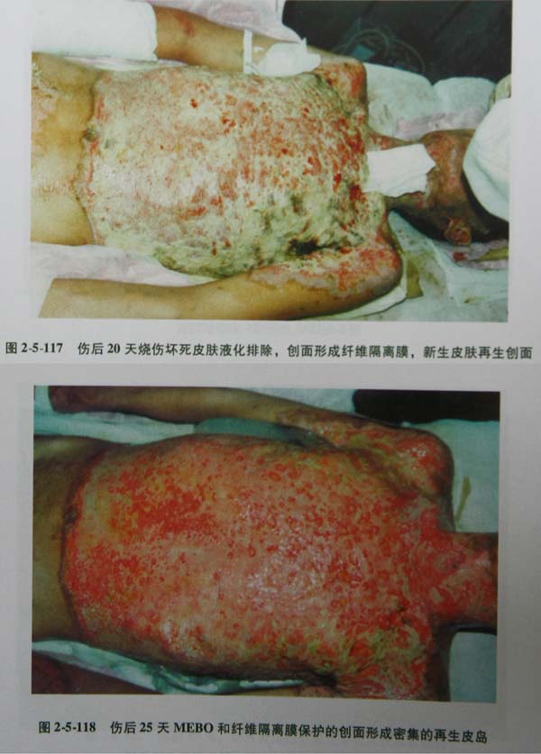 菲彩国际集团_第四节 真皮深层损伤治疗手艺