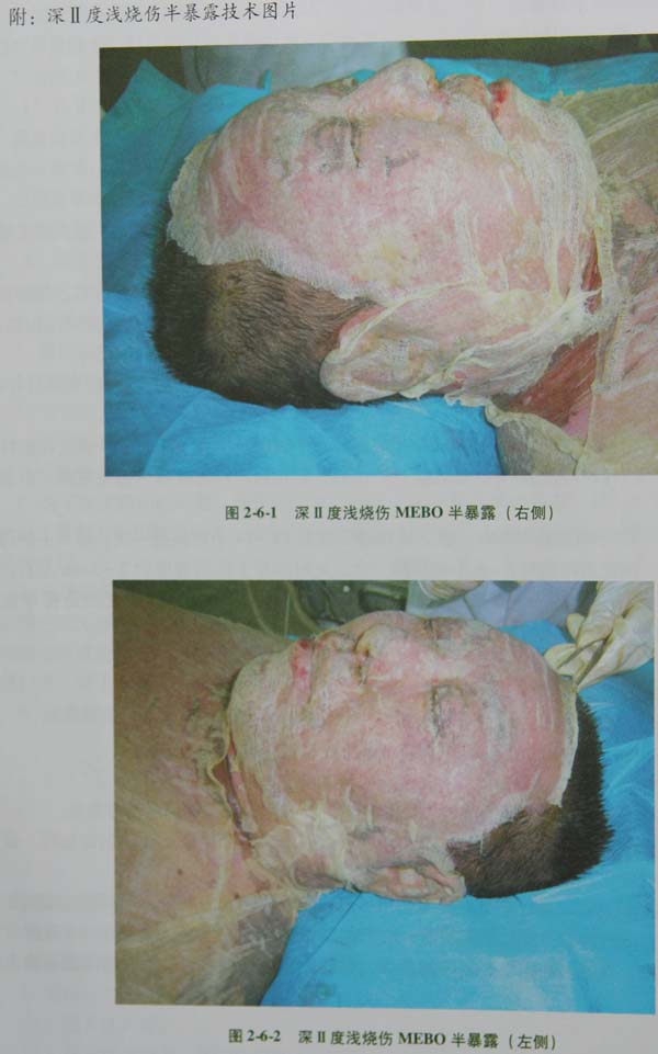菲彩国际集团_第八节 烧伤营养照顾护士手艺