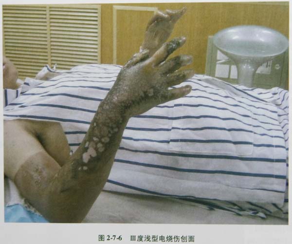 菲彩国际集团_第三节 全层皮肤烧伤焦痂搔刮减压术