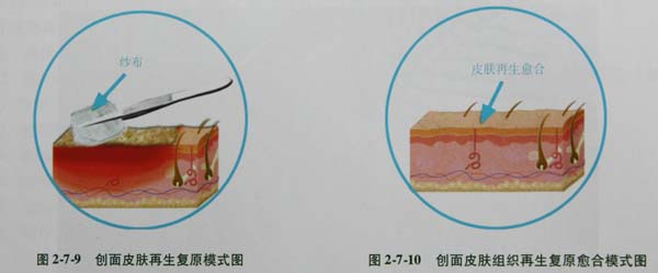 菲彩国际集团_第三节 全层皮肤烧伤焦痂搔刮减压术