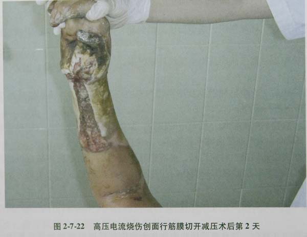 菲彩国际集团_第六节 肌肉烧伤筋膜切开减压术