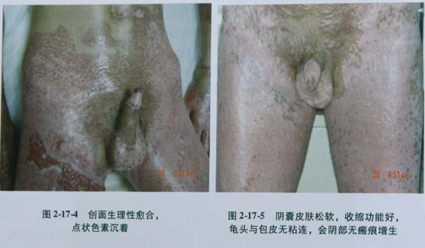 菲彩国际集团_第二节 会阴部深度烧伤治疗手艺
