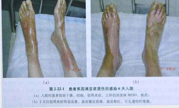 菲彩国际集团_第五节 足部Ⅲ度深型烧伤治疗手艺