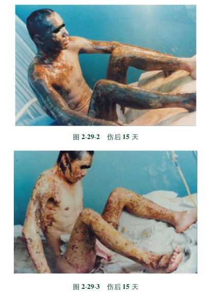 菲彩国际集团_第三节 硫酸烧伤治疗手艺