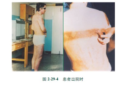 菲彩国际集团_第三节 硫酸烧伤治疗手艺