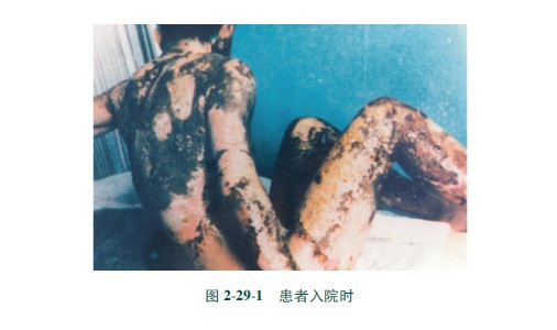 菲彩国际集团_第三节 硫酸烧伤治疗手艺