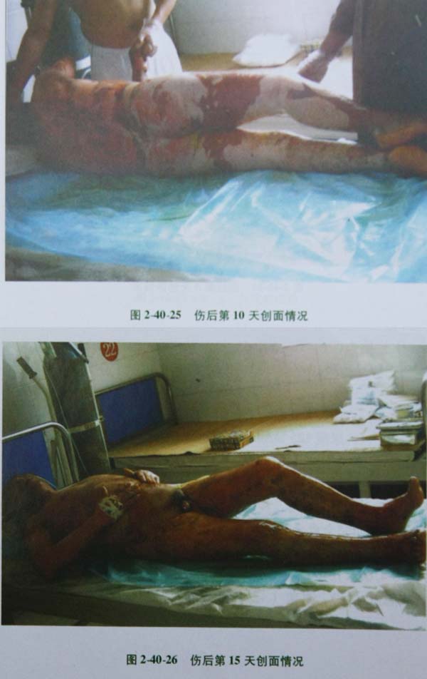菲彩国际集团_第二节 特大面积烧伤病例(2)治疗纪录