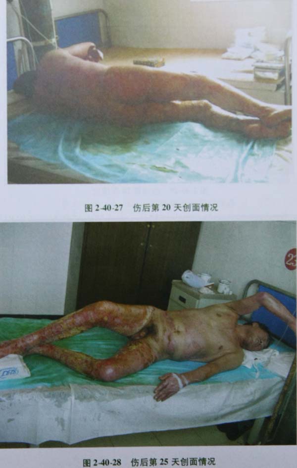 菲彩国际集团_第二节 特大面积烧伤病例(2)治疗纪录