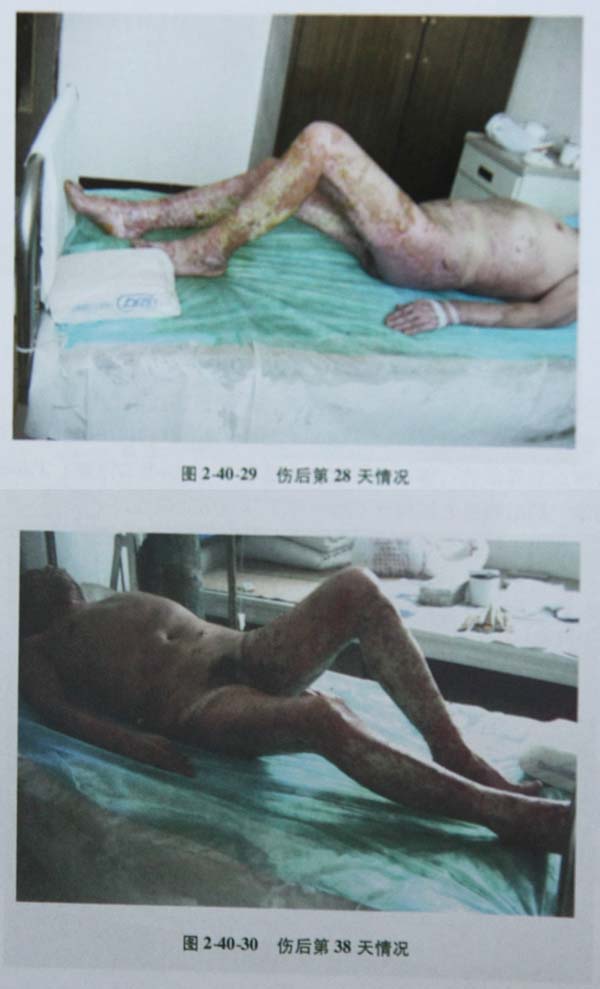 菲彩国际集团_第二节 特大面积烧伤病例(2)治疗纪录