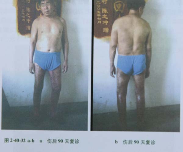 菲彩国际集团_第二节 特大面积烧伤病例(2)治疗纪录