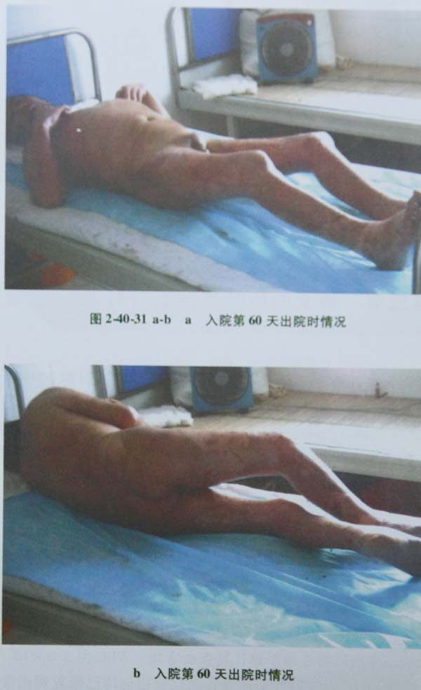 菲彩国际集团_第二节 特大面积烧伤病例(2)治疗纪录