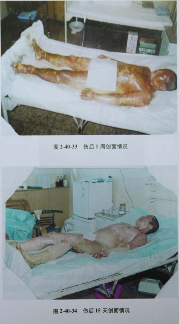 菲彩国际集团_第三节 特大面积烧伤病例(3)治疗纪录