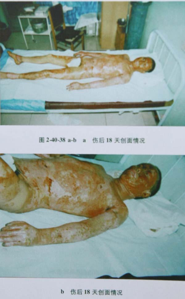 菲彩国际集团_第四节 特大面积烧伤病例(4)治疗纪录